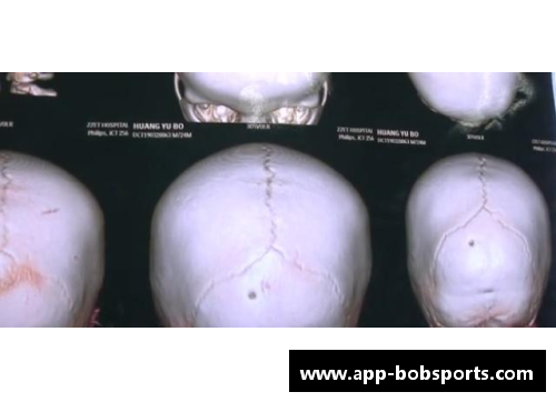 bobsports平台官方网站球员枕骨骨折：危险源与康复策略 - 副本